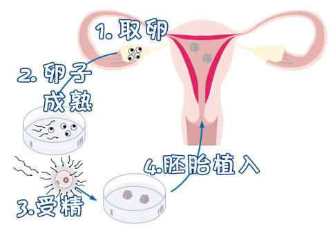 私人拉拉借卵代怀助孕咨询生殖医学中心
